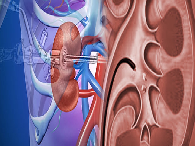 Endourology (Vesical Septum)