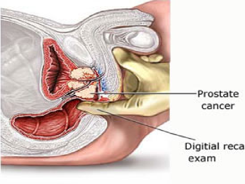 Use Of Holmium Laser In Urology